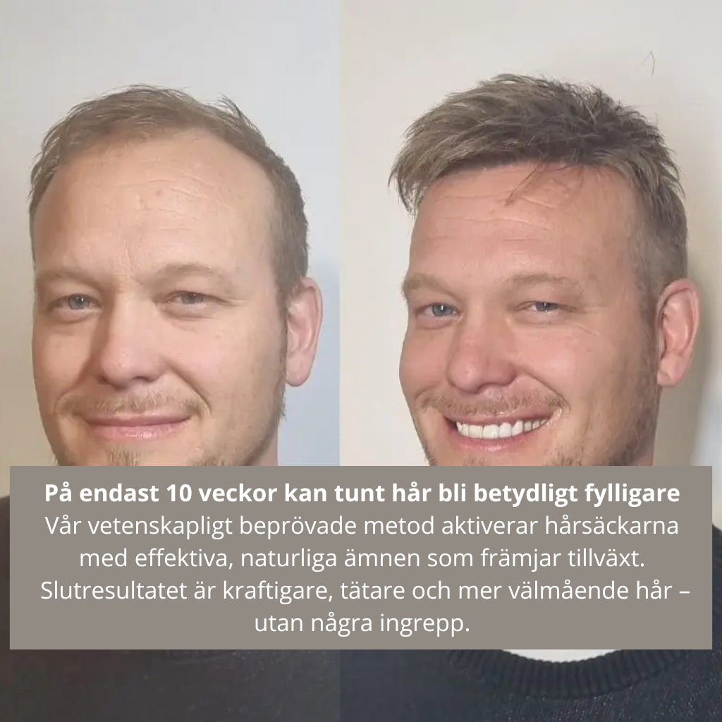 HairRevive Hårväxtsystem™