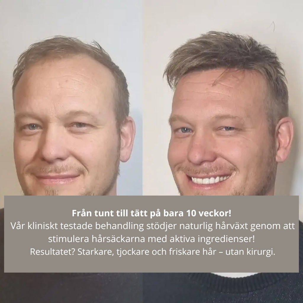 AlphaRevive™ Hårväxtsystem